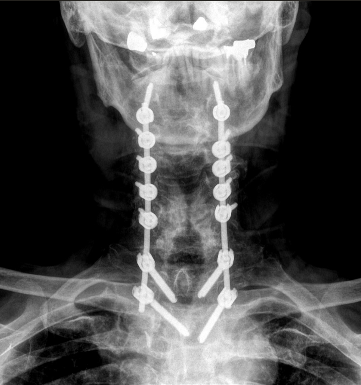 Cervical Laminectomy