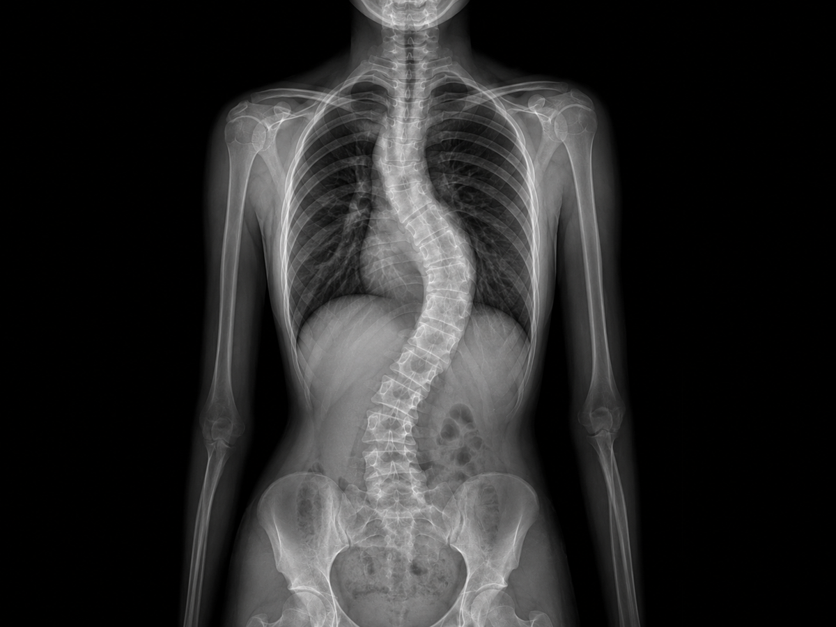 Spinal Deformity