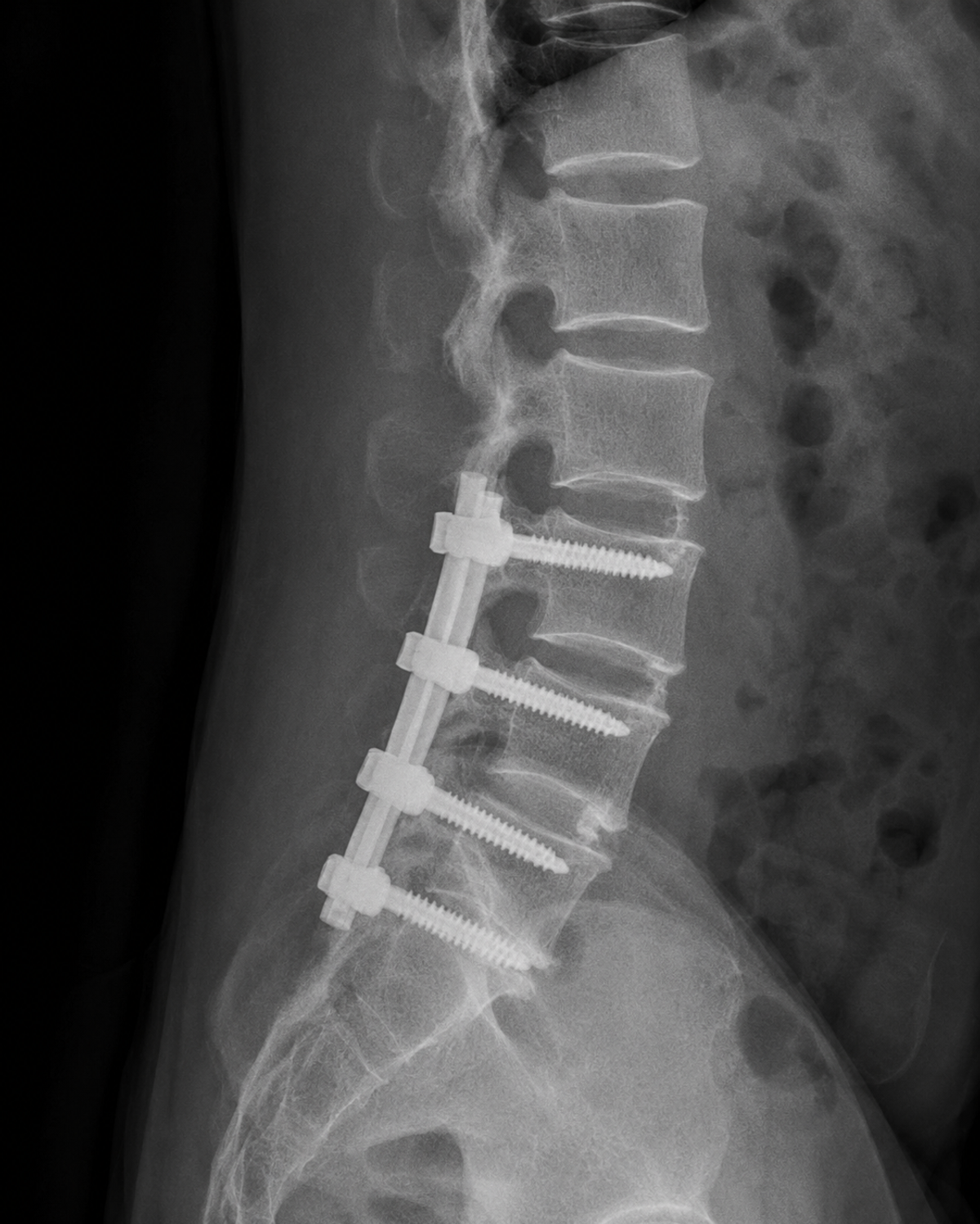 Spinal Fusion