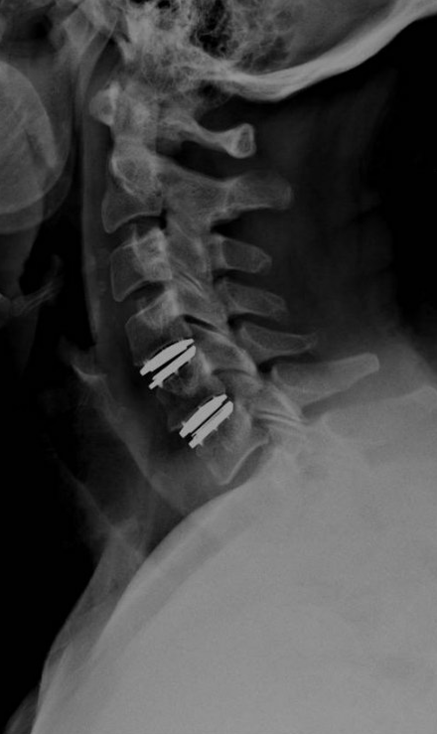 Cervical Disc Replacement