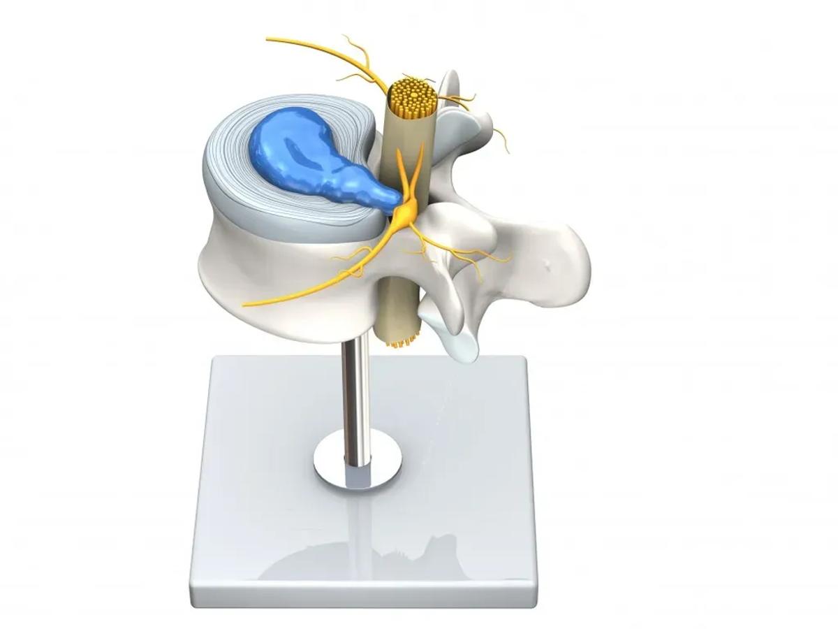 What is a Lumbar Disc Herniation?