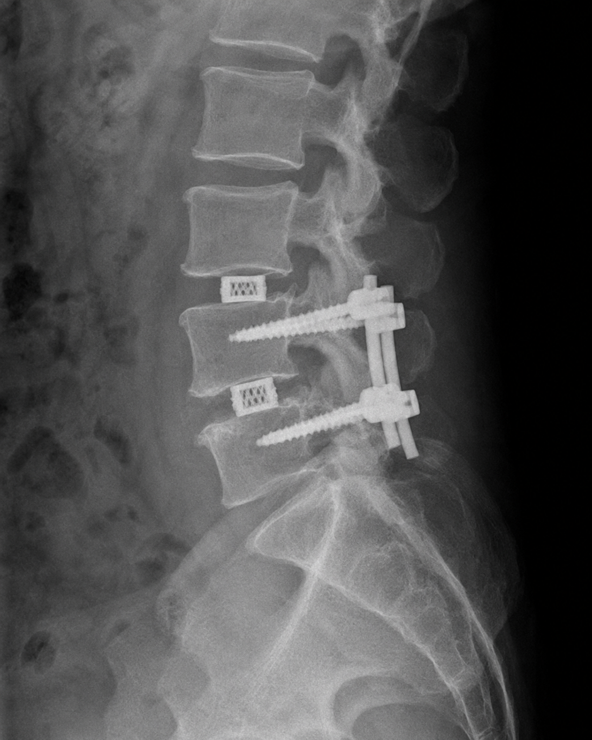 Posterior Lumbar Interbody Fusion PLIF