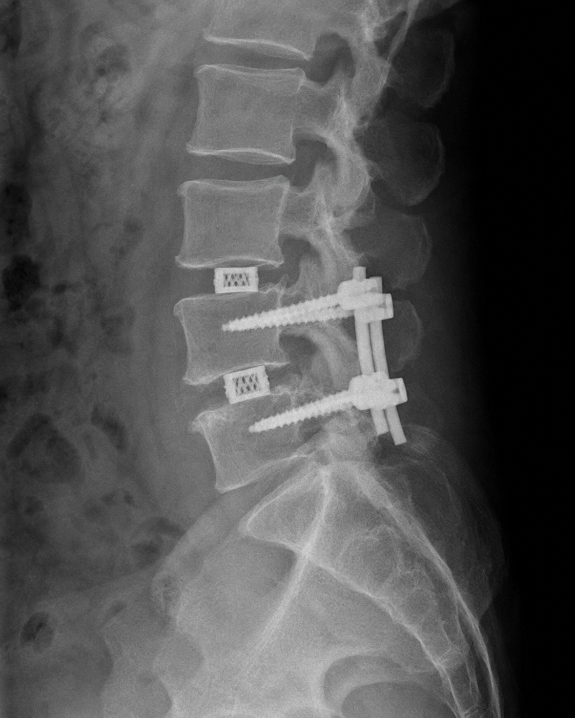 Posterior Lumbar Interbody Fusion PLIF