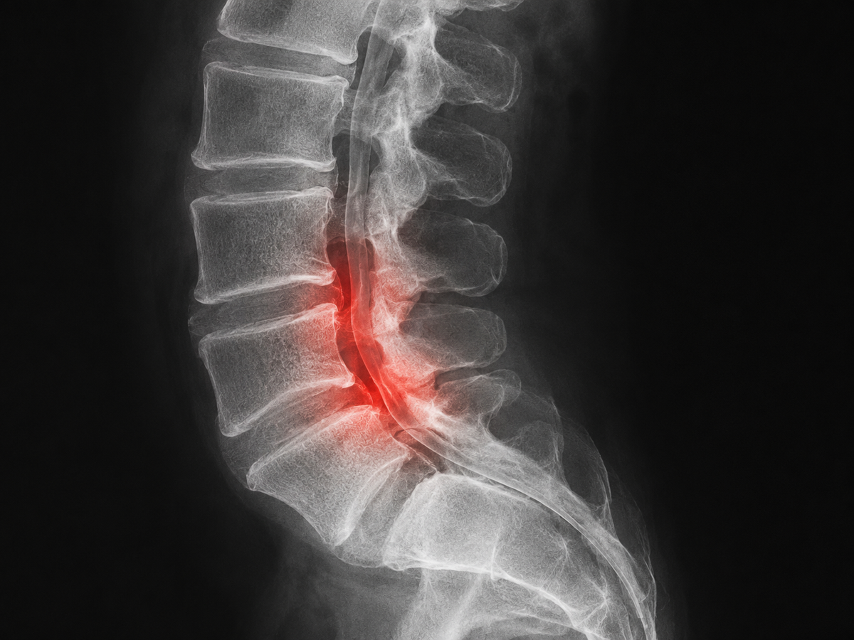 Spinal Stenosis