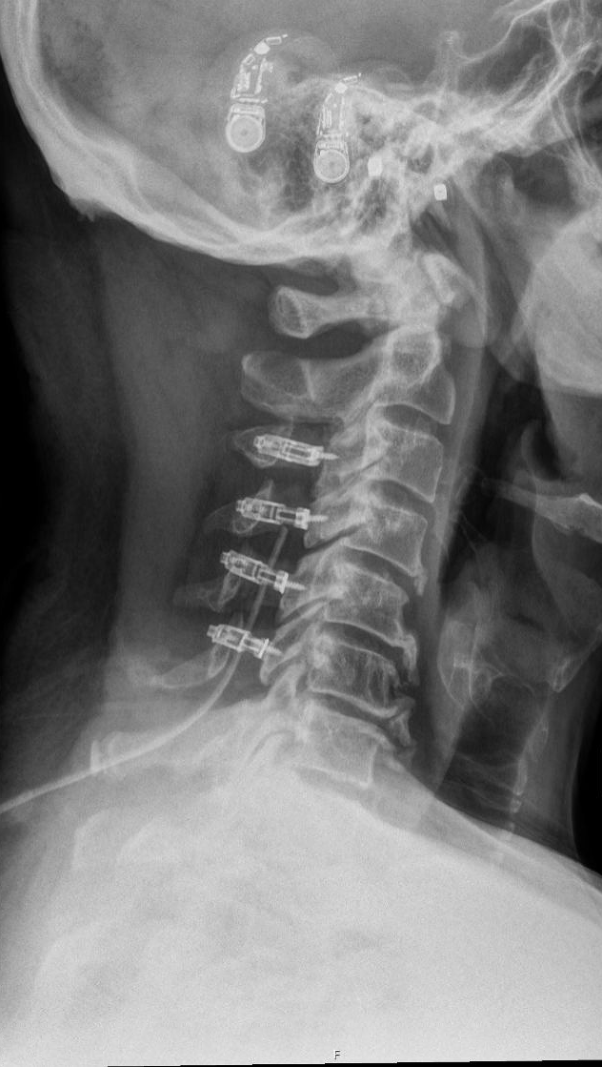 Cervical Laminoplasty