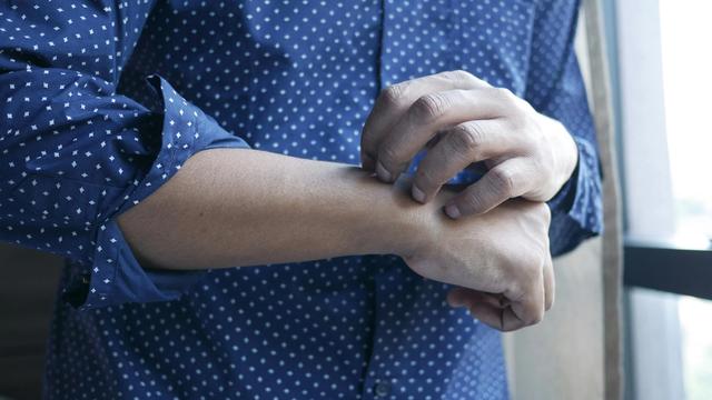 Alerginis kontaktinis dermatitas