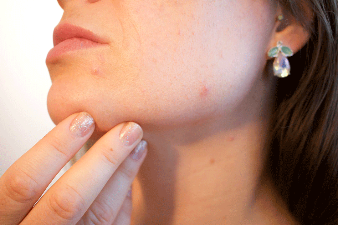Say Goodbye to Acne: Routines and Products to Combat It