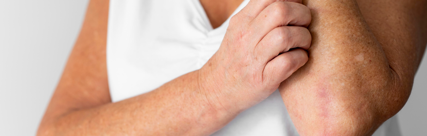Psoriasis: What It Is, Symptoms and Causes