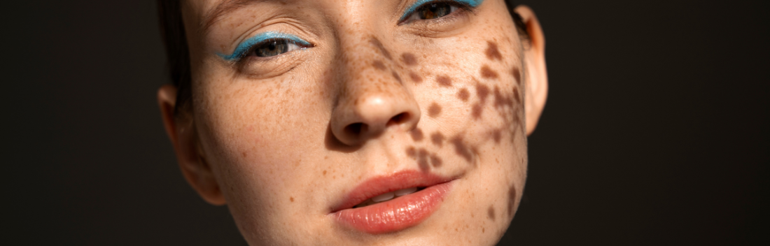 The perfect depigmenting routine for summer