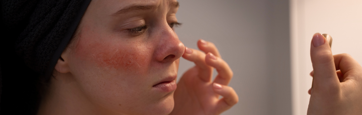 Rosacea-prone skin: symptoms, causes and treatment