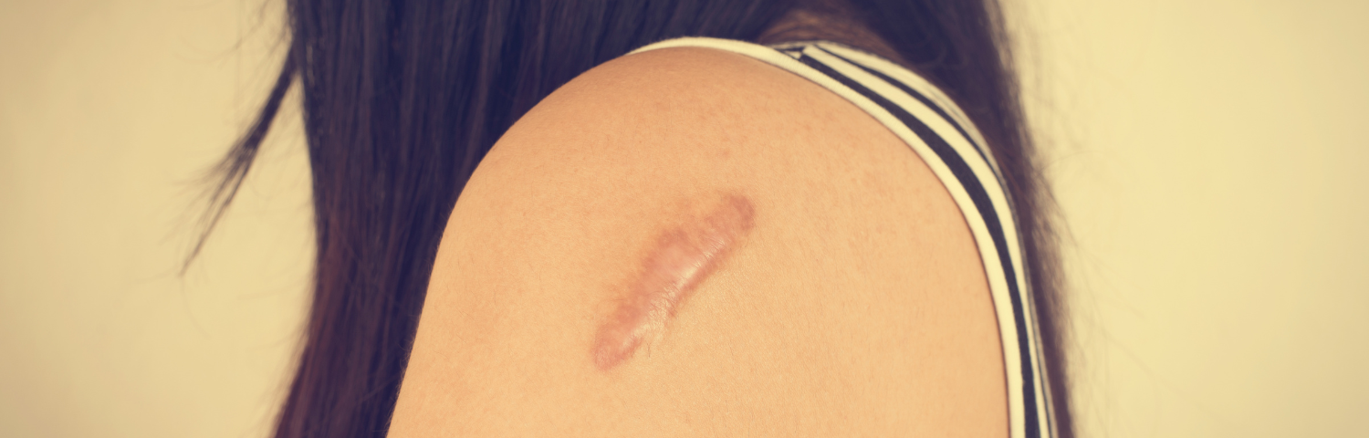 Sun and scars: how should I protect my skin?