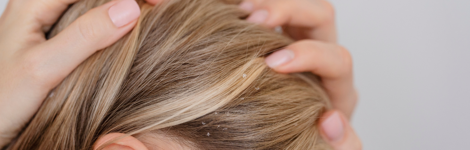 Seborrhoeic Dermatitis of the Scalp: Causes, Symptoms and Treatments