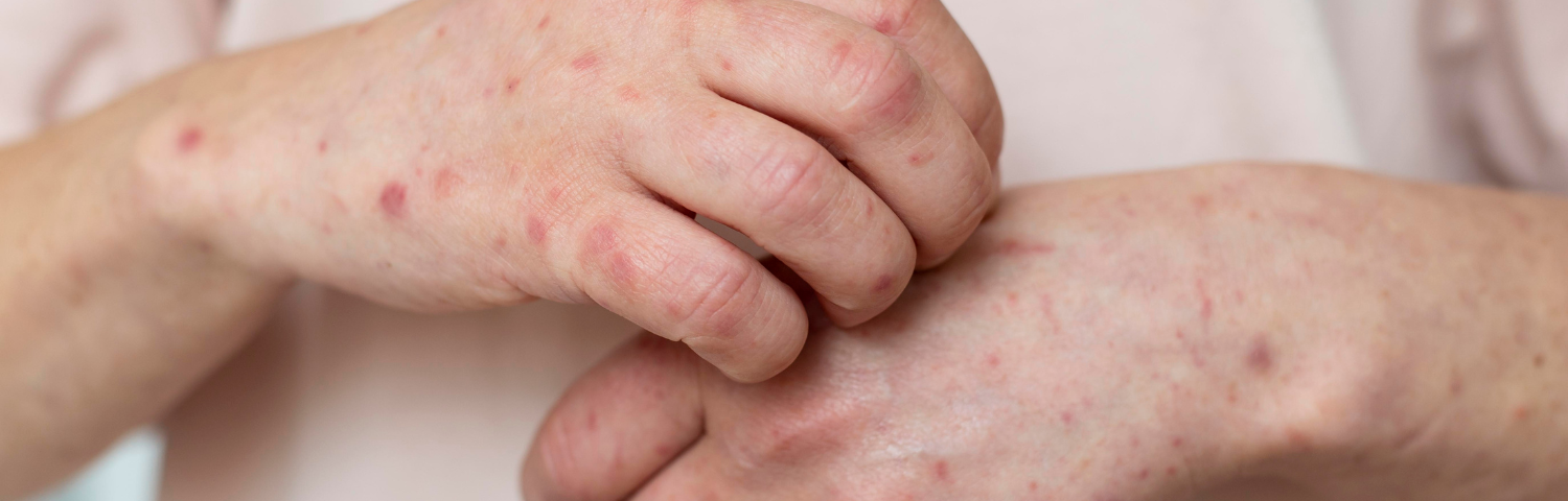 Atopic Dermatitis: What It Is and How It Manifests
