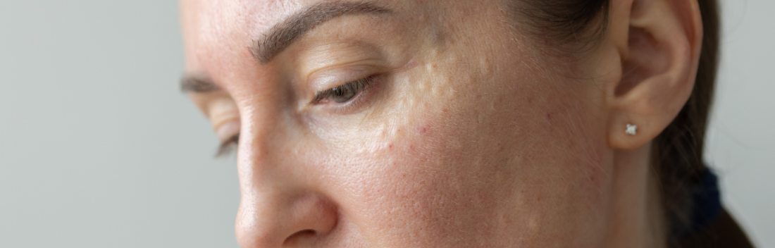 Damaged skin barrier: how to restore it with proper care and a repairing routine