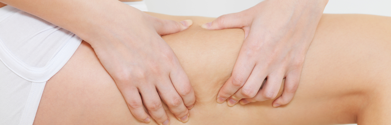 Cellulite: What It Is and How We Can Treat It