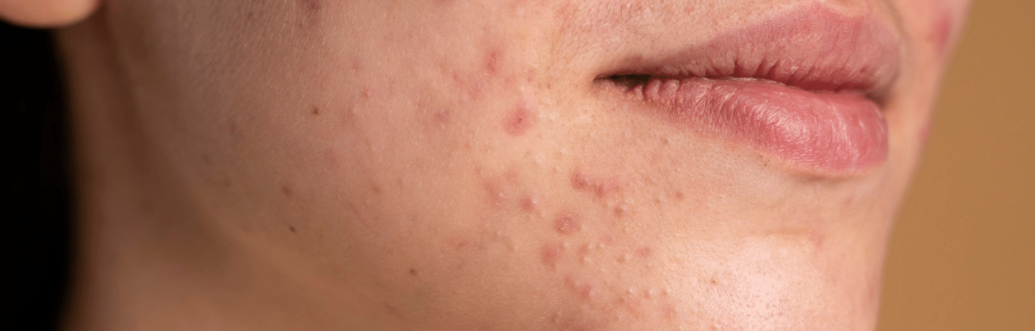 The best acne serums: get your skin back without blemishes