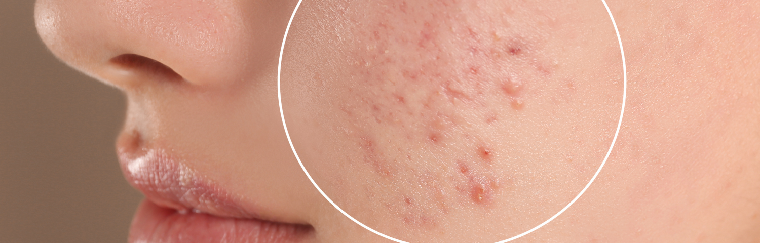 Products to Say Goodbye to Acne
