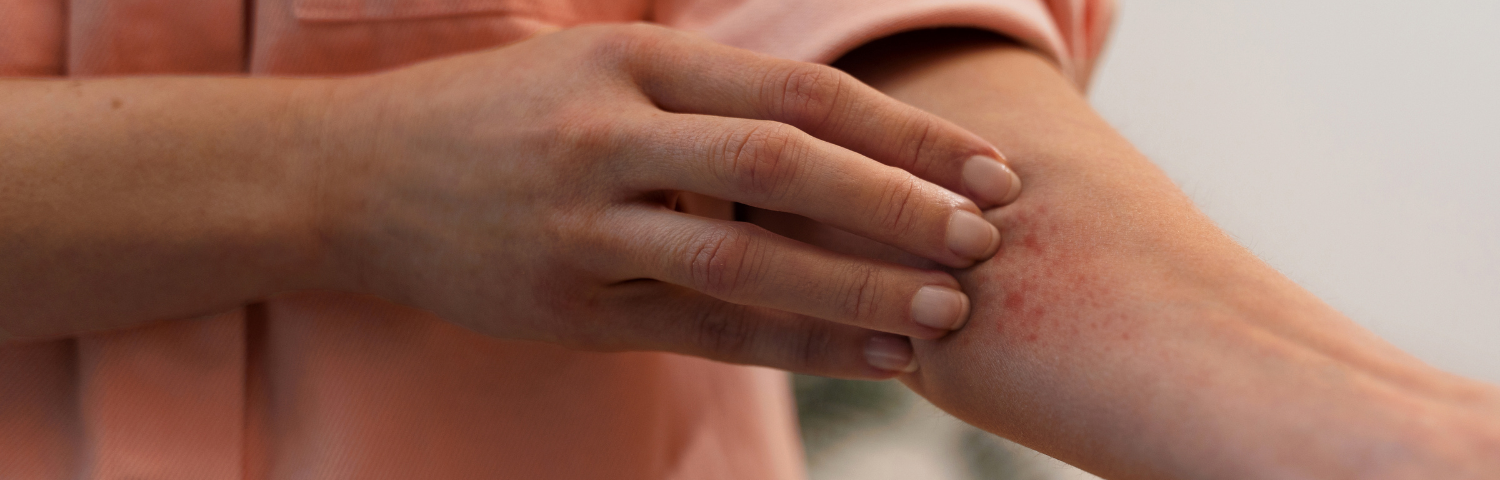 How to Treat Eczema on the Skin: Tips and Products