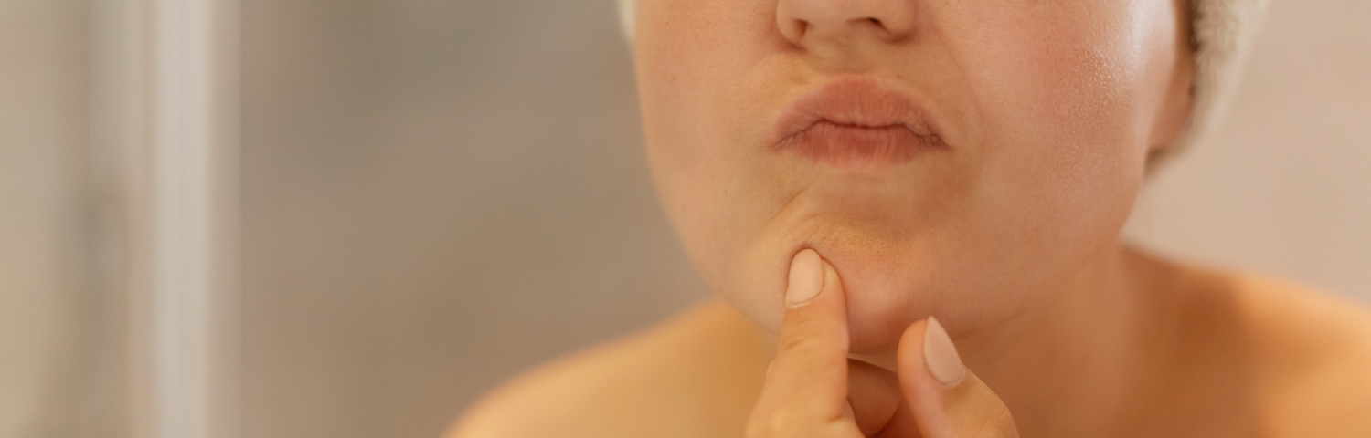 Adult acne routine in five steps