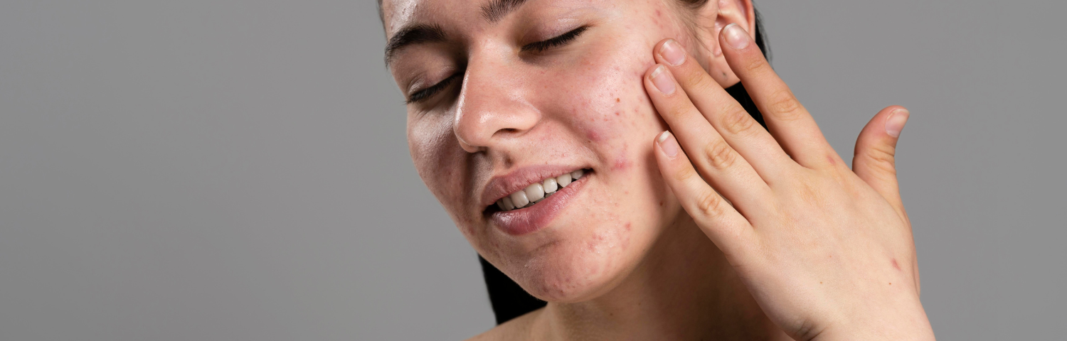 Spots after sun exposure: why does acne get worse after summer?