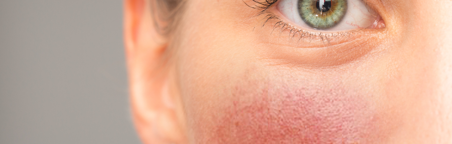 Symptoms, causes and treatments for rosacea-prone skin