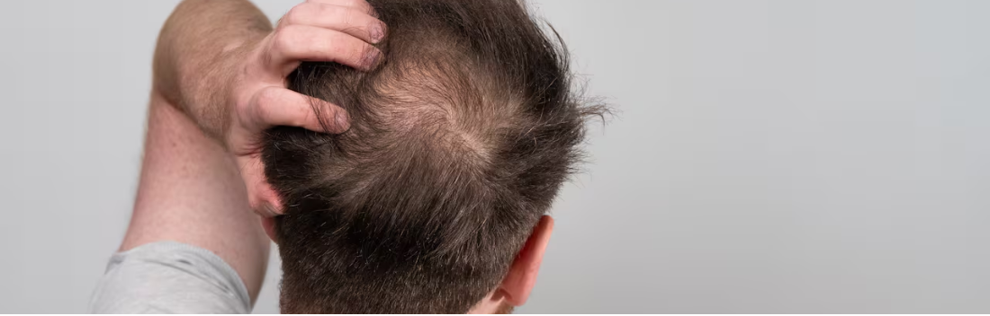 Androgenetic alopecia