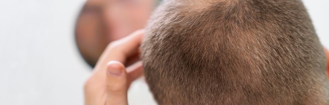 The best hair loss treatment for men