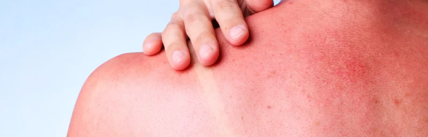 Sunburned skin