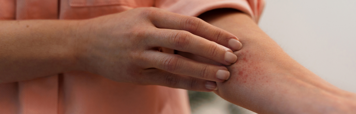 Atopic dermatitis care