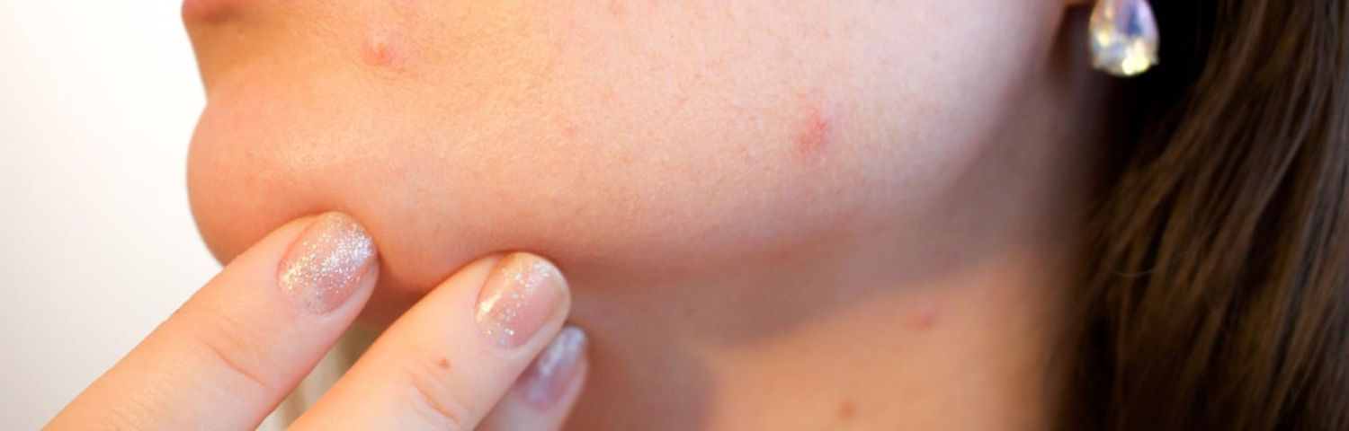 Acne during your period: why it happens and how to prevent it