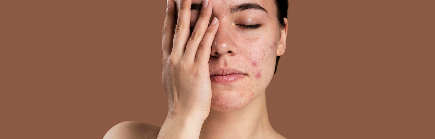 Most effective ingredients to fight acne and improve overall skin health