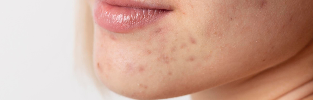 How to eliminate acne marks