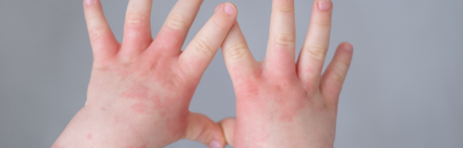 Atopic skin in babies and children: causes and treatment