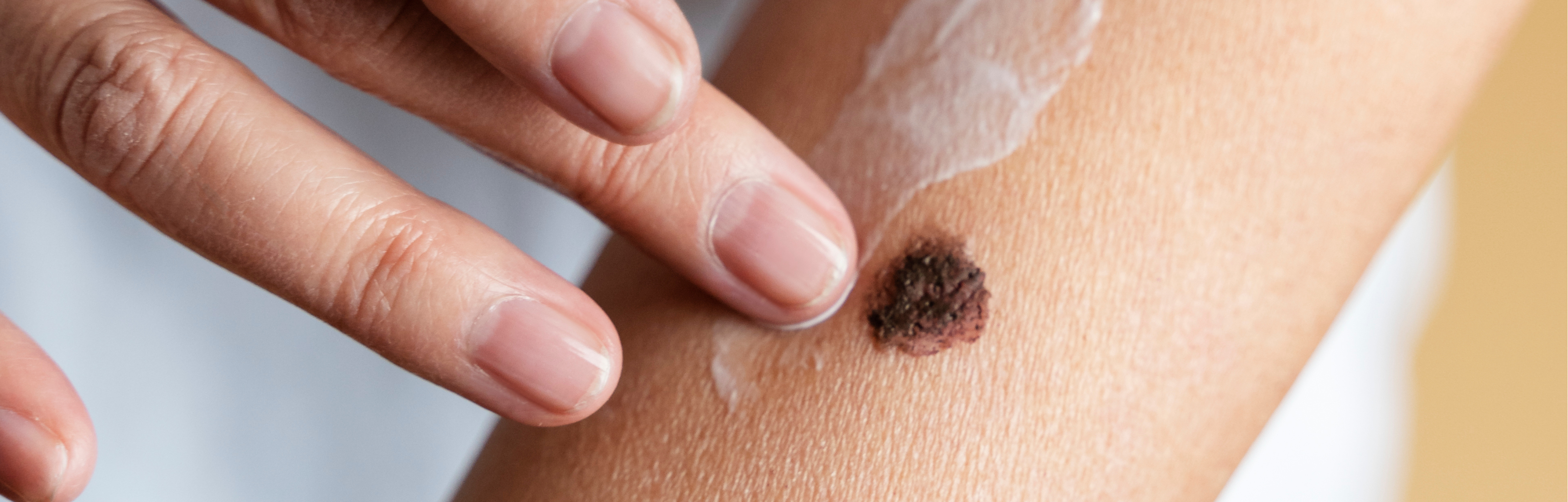 Melanoma: causes, symptoms and how to prevent it