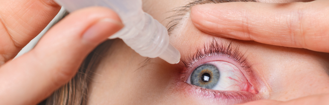 Dry eye syndrome