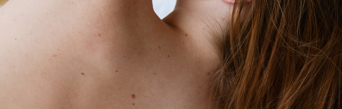 Body acne