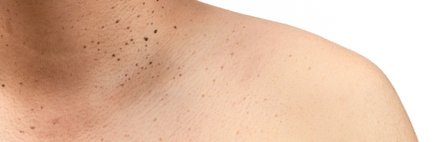 Warts: types and treatments