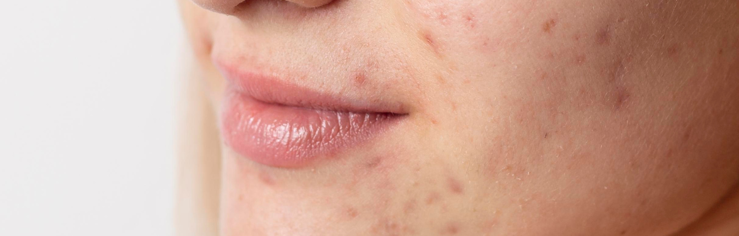 Acne marks: how can you get rid of them?