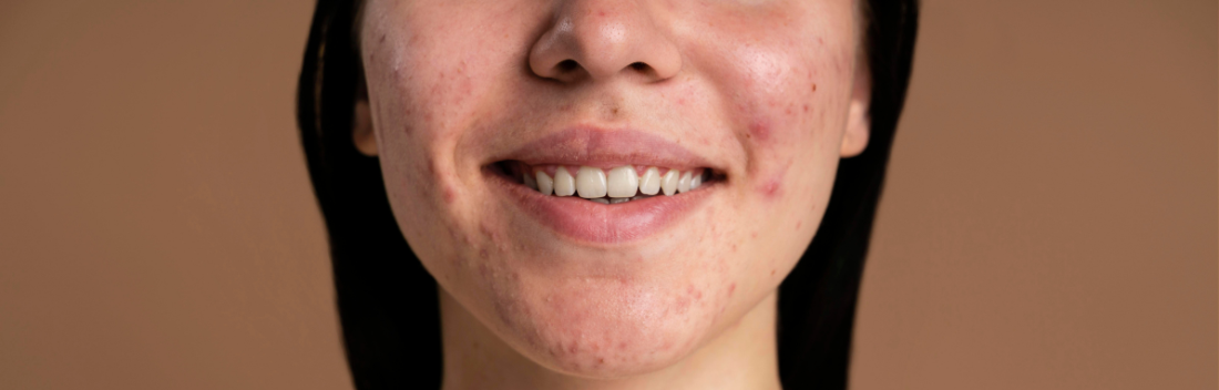 Adult acne: why it appears and how to treat it effectively