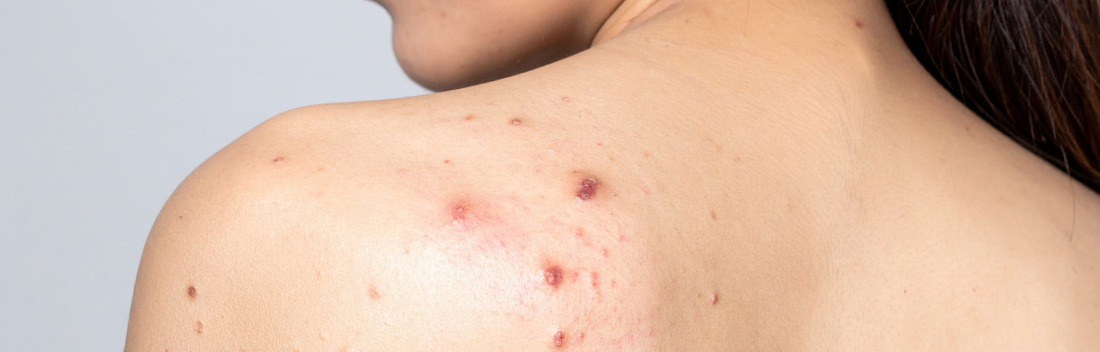 Back pimples: causes and treatment to improve body skin