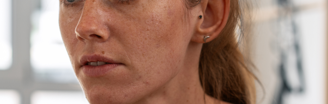 The best anti-blemish treatment for after summer