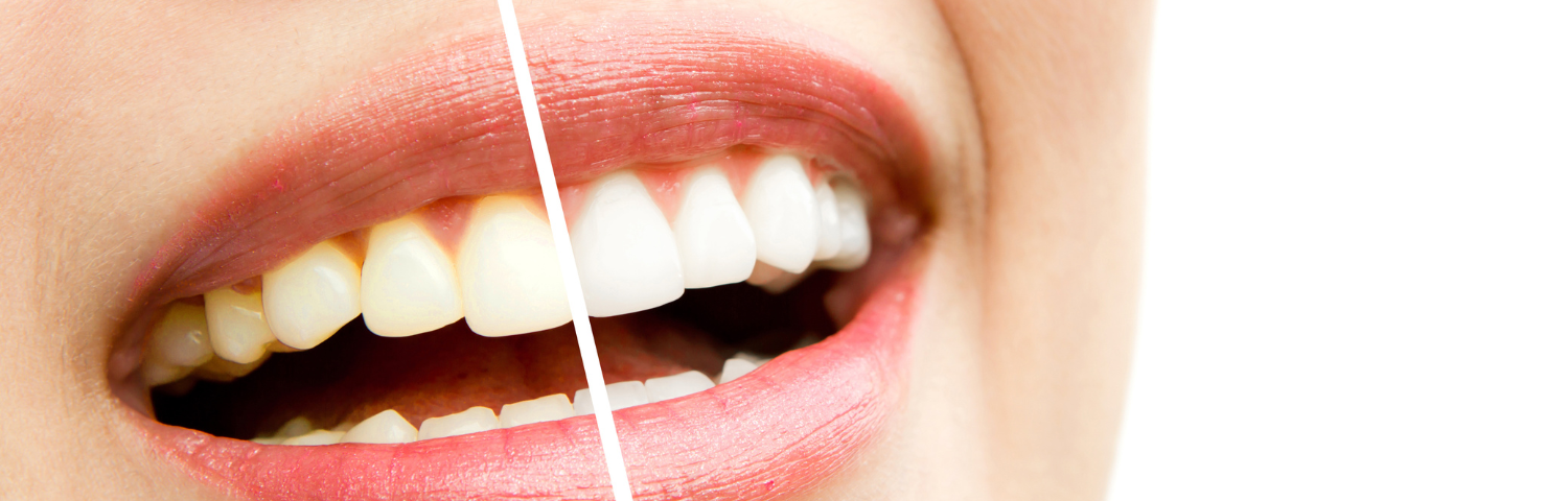 Whitening Products for a Dazzling Smile