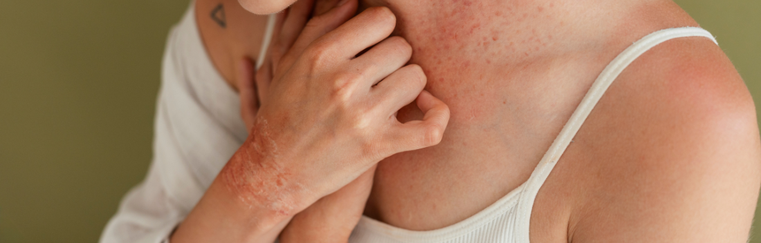 How to treat red and irritated skin and reduce redness