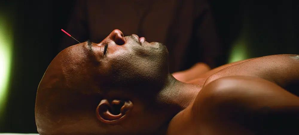 Black man getting acupuncture.