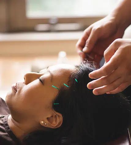 Asian woman receiving acupuncture therapy.