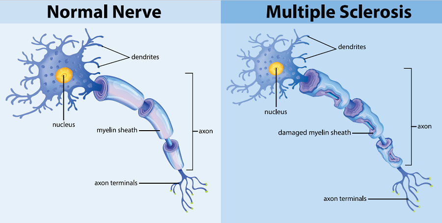 Illustration comparing a normal nerve to one with damaged myelin.