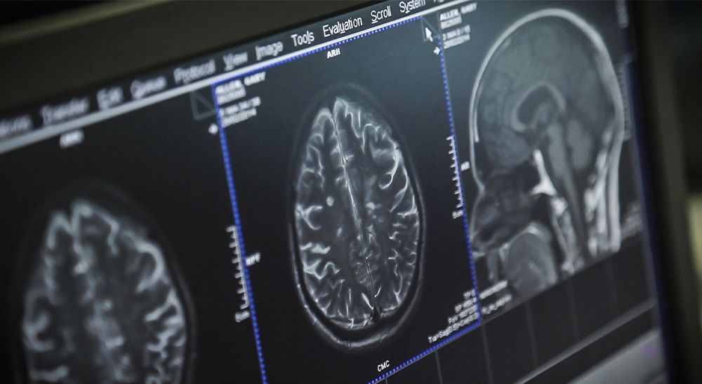 A screen shows MS lesions.