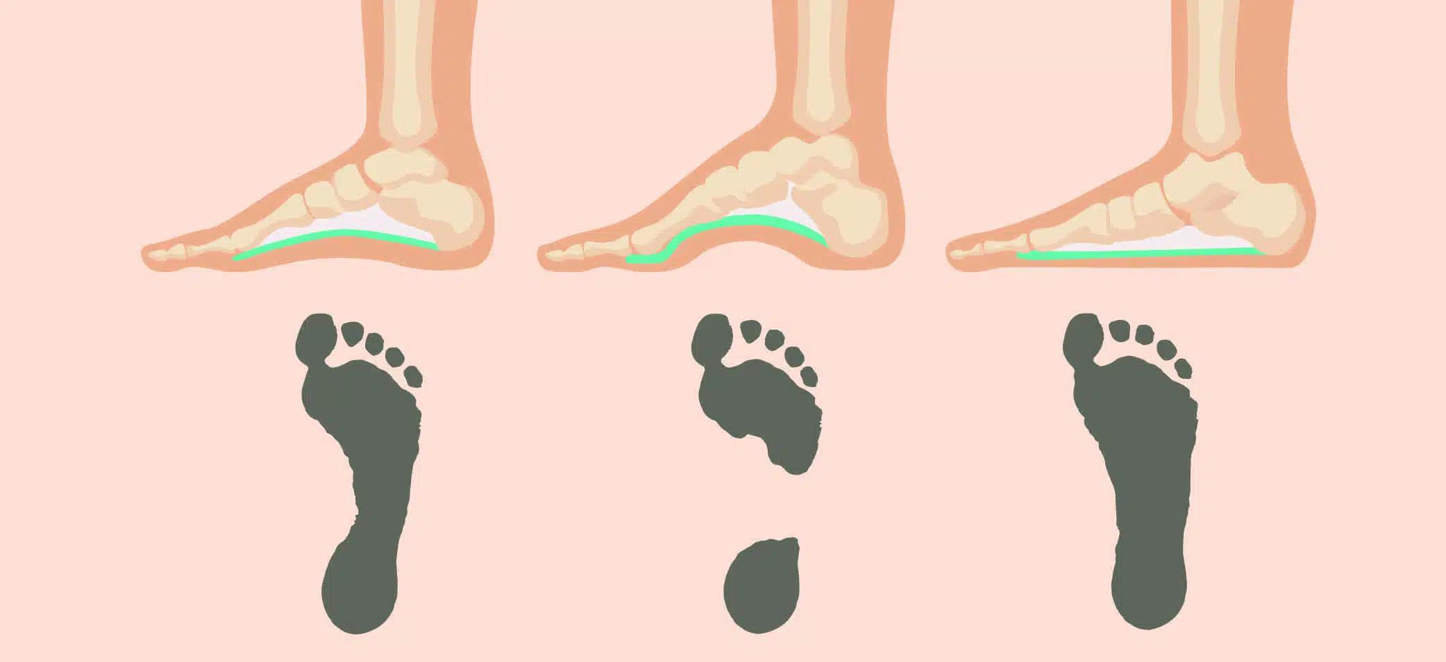 Get To Know Your Feet: Arch Types | National MS Society