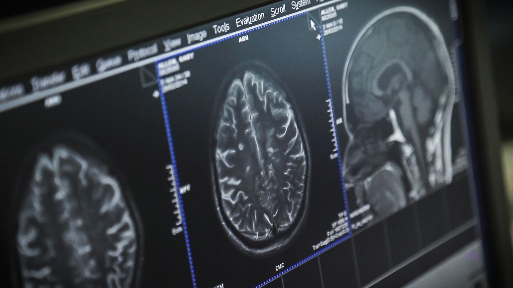 A brain scan in black, white and blue