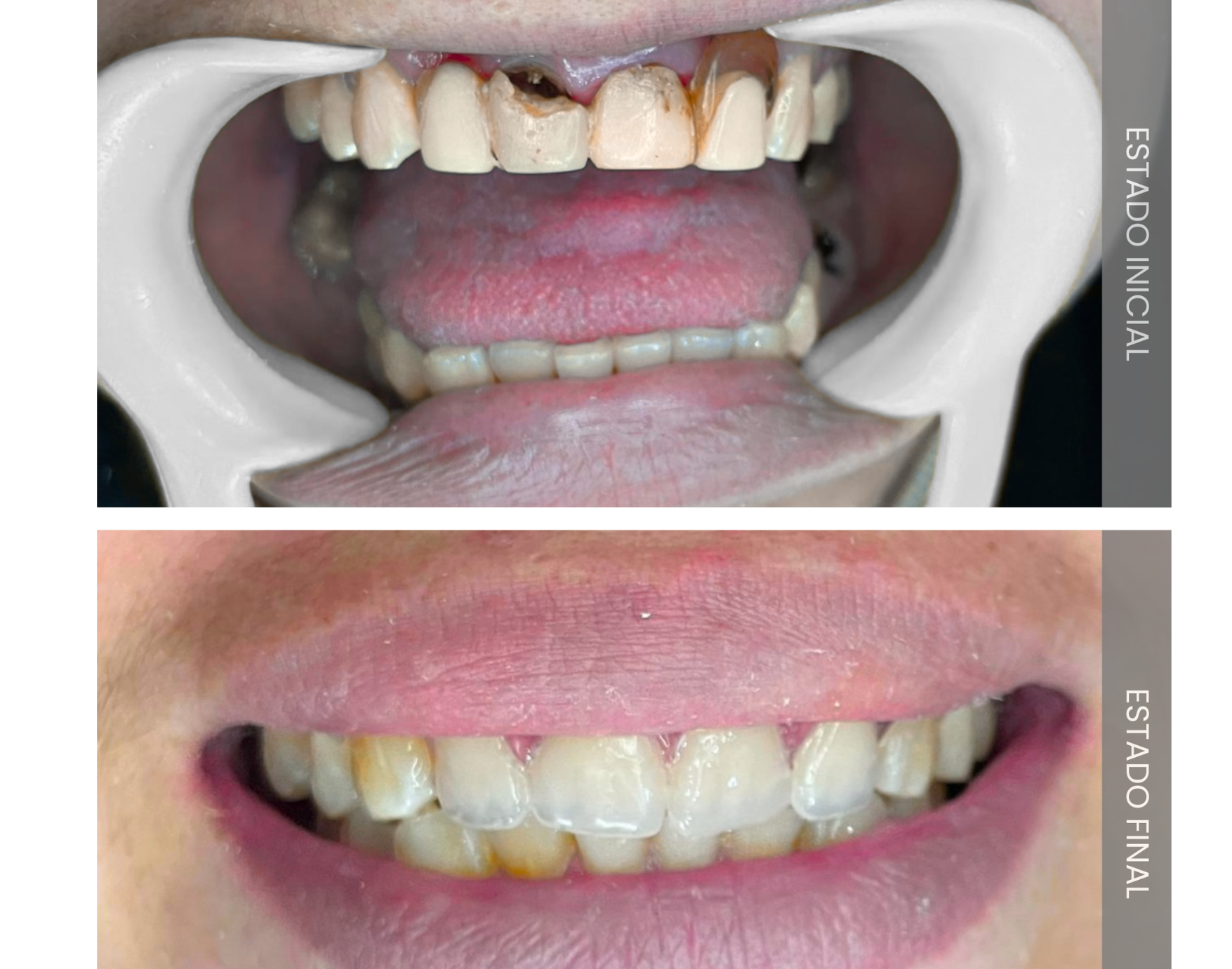 Resina Dental Estética